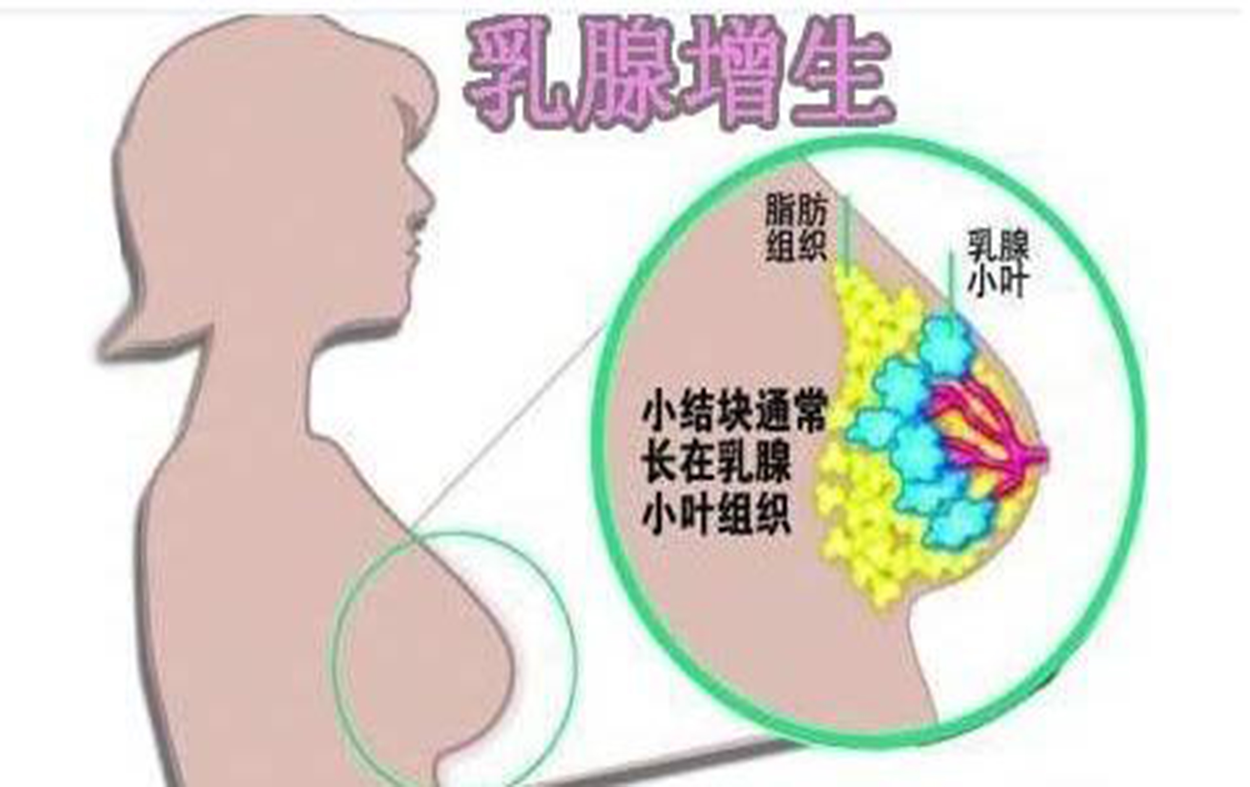 乳腺疾病知多少