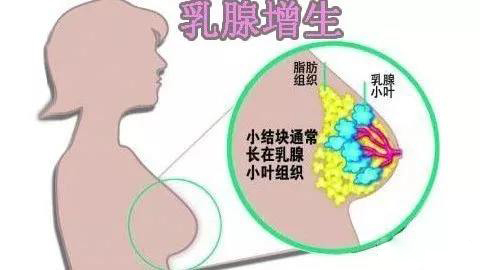 乳腺增生的常见症状