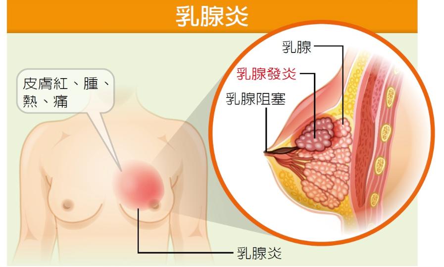 乳腺炎